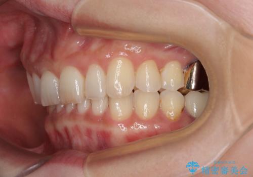 デコボコの歯とむし歯 インビザライン矯正治療とむし歯治療の治療後