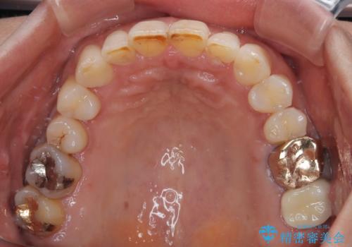 デコボコの歯とむし歯　インビザライン矯正治療とむし歯治療の治療後