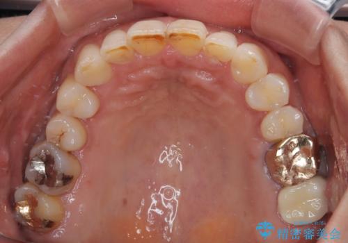 デコボコの歯とむし歯 インビザライン矯正治療とむし歯治療の治療後