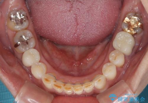 デコボコの歯とむし歯 インビザライン矯正治療とむし歯治療の治療後