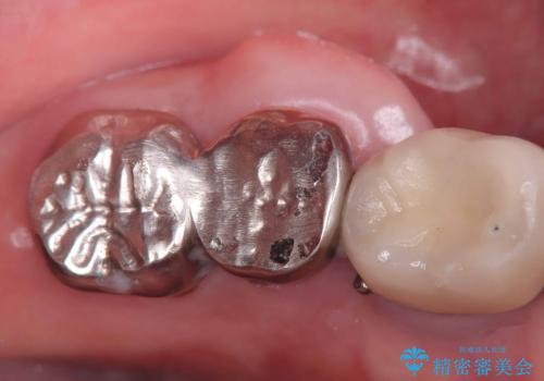 【1Dayインプラント治療! 低侵襲で短期間での治療】 咬むと歯が痛い! 歯根破折の治療前