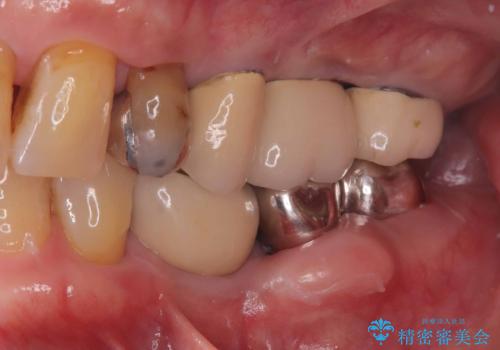 【1Dayインプラント治療! 低侵襲で短期間での治療】 咬むと歯が痛い! 歯根破折の治療前