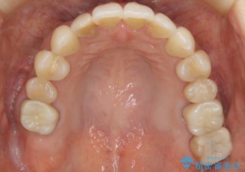 【非抜歯】前歯の反対咬合をマウスピースで治すの治療後