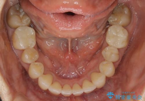 【非抜歯】前歯の反対咬合をマウスピースで治すの治療後