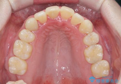 [突き出た前歯を引っ込めたい] ワイヤー矯正とマウスピース矯正の併用治療の治療後