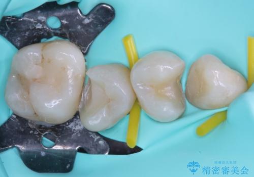 放置したむし歯 抜歯後にインプラントで補綴治療の治療中