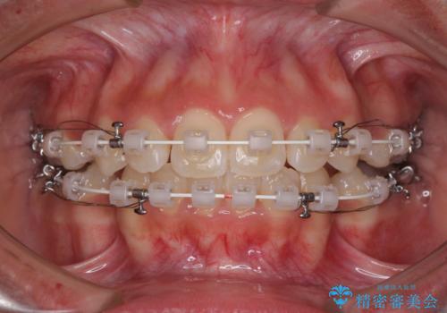 くちばしのように突出した前歯　口元を下げる抜歯矯正の治療中