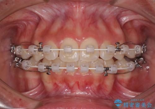 くちばしのように突出した前歯 口元を下げる抜歯矯正の治療中