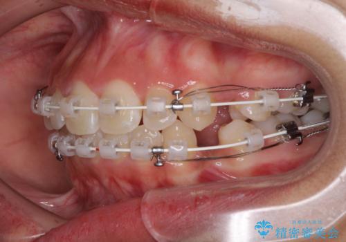 くちばしのように突出した前歯　口元を下げる抜歯矯正の治療中