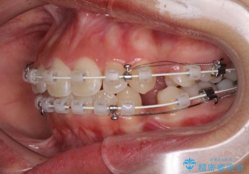 くちばしのように突出した前歯 口元を下げる抜歯矯正の治療中