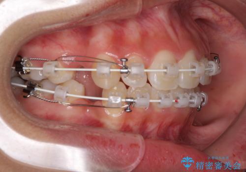 くちばしのように突出した前歯　口元を下げる抜歯矯正の治療中