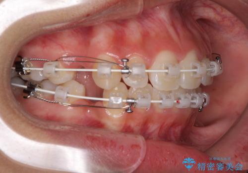くちばしのように突出した前歯 口元を下げる抜歯矯正の治療中