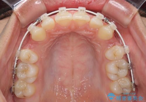くちばしのように突出した前歯　口元を下げる抜歯矯正の治療中