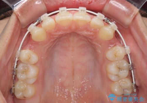 くちばしのように突出した前歯 口元を下げる抜歯矯正の治療中