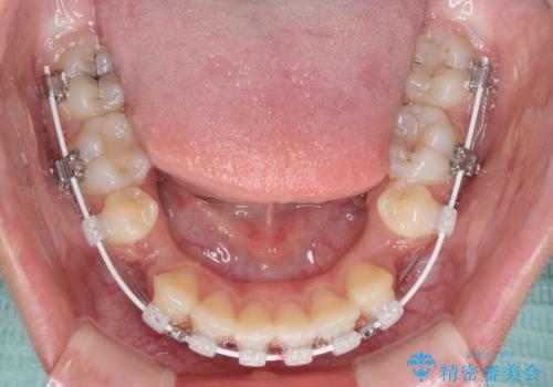 くちばしのように突出した前歯　口元を下げる抜歯矯正の治療中
