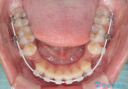 くちばしのように突出した前歯 口元を下げる抜歯矯正の治療中
