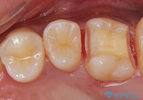 コンタクトカリエス治療。の治療中