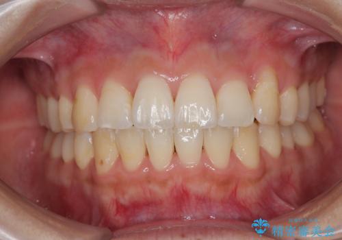 急速拡大装置　狭い歯列を拡大してワイヤー装置で短期間治療の症例 治療後