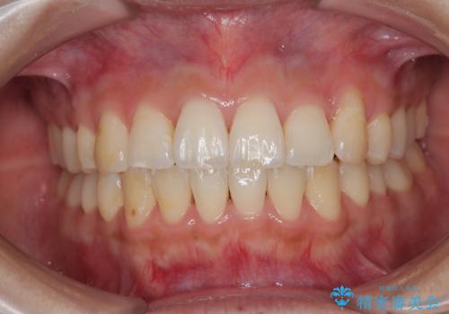 急速拡大装置 狭い歯列を拡大してワイヤー装置で短期間治療