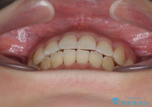 急速拡大装置 狭い歯列を拡大してワイヤー装置で短期間治療の治療後