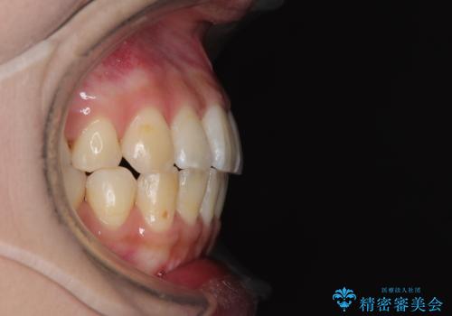 急速拡大装置 狭い歯列を拡大してワイヤー装置で短期間治療の治療後