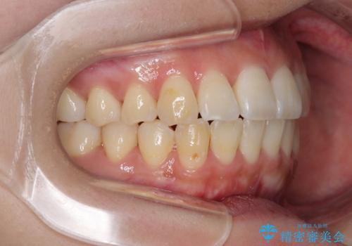 急速拡大装置 狭い歯列を拡大してワイヤー装置で短期間治療の治療後