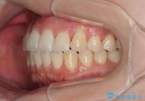 急速拡大装置 狭い歯列を拡大してワイヤー装置で短期間治療の治療後