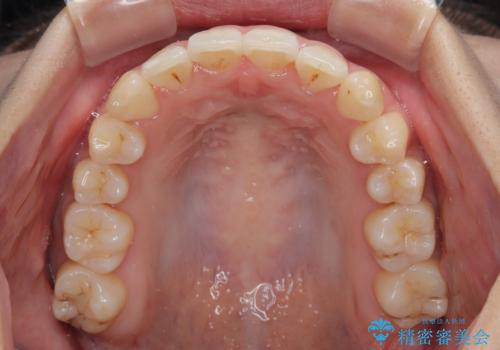 急速拡大装置　狭い歯列を拡大してワイヤー装置で短期間治療の治療後