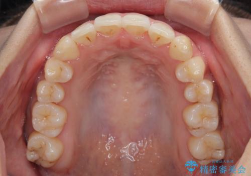 急速拡大装置 狭い歯列を拡大してワイヤー装置で短期間治療の治療後