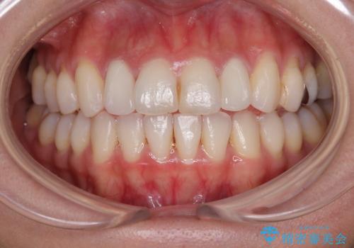 前歯をきれいにしたい オールセラミッククラウンにによる補綴