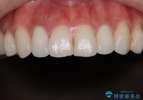 前歯をきれいにしたい オールセラミッククラウンにによる補綴の治療後