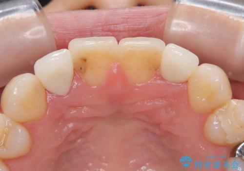 前歯をきれいにしたい オールセラミッククラウンにによる補綴の治療後