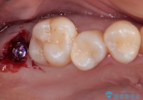 放置したむし歯　抜歯後にインプラントで補綴治療の治療中