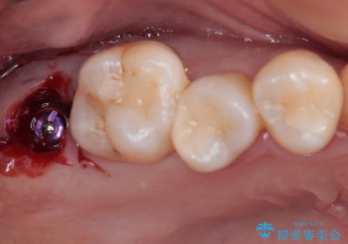 放置したむし歯 抜歯後にインプラントで補綴治療の治療中