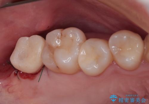 放置したむし歯　抜歯後にインプラントで補綴治療の治療後