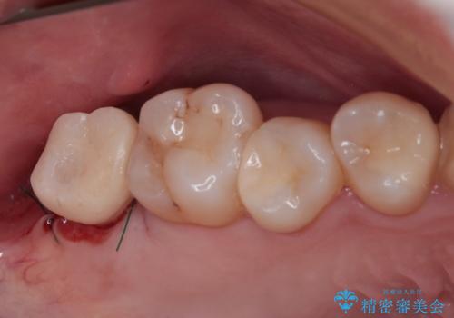 放置したむし歯 抜歯後にインプラントで補綴治療の治療後