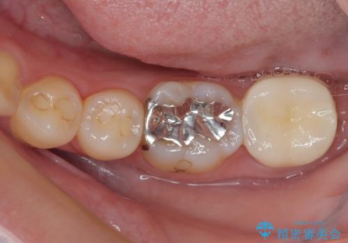 歯医者が怖い 1DAYインプラントで外科処置の恐怖を軽減の治療後