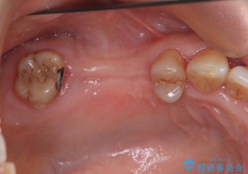 治療中で放置　インプラントでしっかりと咬めるようにの治療前