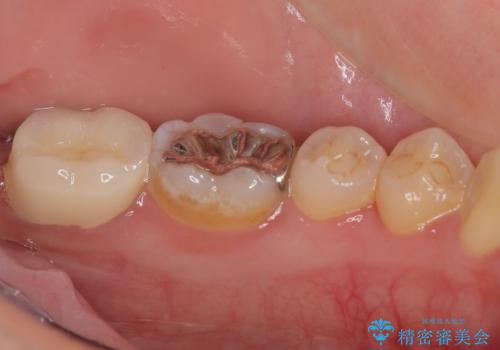 歯医者が怖い 1DAYインプラントで外科処置の恐怖を軽減の治療後