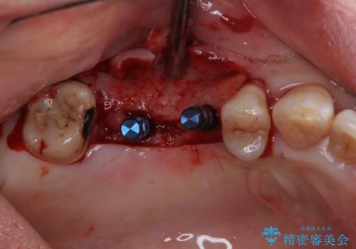治療中で放置 インプラントでしっかりと咬めるようにの治療中