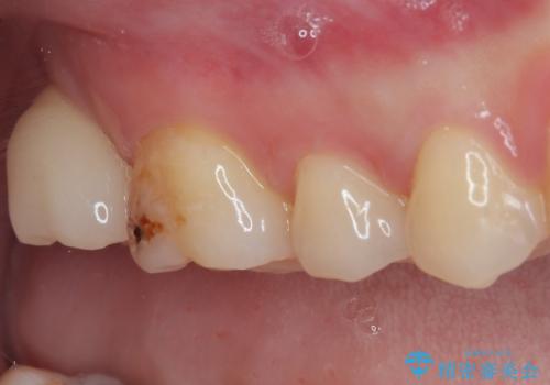 歯医者が怖い 1DAYインプラントで外科処置の恐怖を軽減の治療後