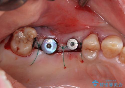治療中で放置　インプラントでしっかりと咬めるようにの治療後