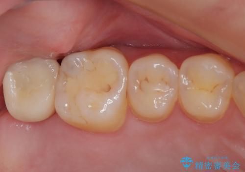 歯医者が怖い 1DAYインプラントで外科処置の恐怖を軽減の症例 治療後