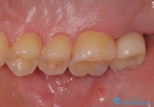 歯医者が怖い 1DAYインプラントで外科処置の恐怖を軽減の治療後