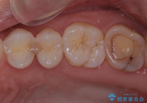 左上がしみて痛い　セラミックインレー修復の治療前