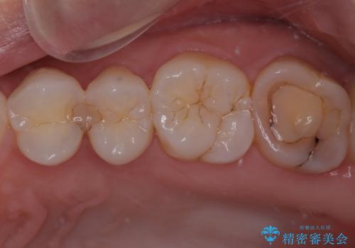 左上がしみて痛い セラミックインレー修復の症例 治療前