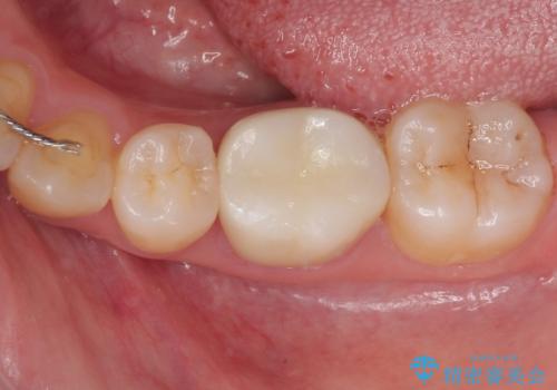 銀歯のところがしみる　オールセラミッククラウンの治療後