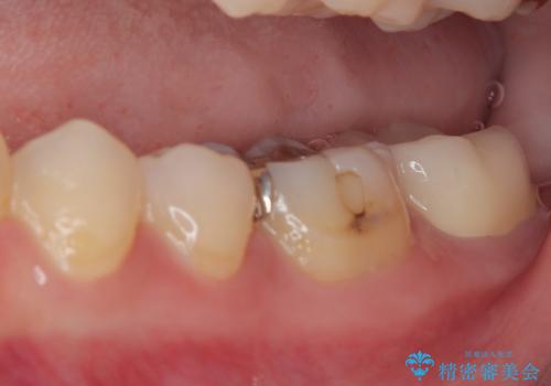 歯医者が怖い 1DAYインプラントで外科処置の恐怖を軽減の治療後