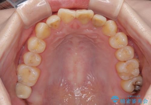 歯医者が怖い 1DAYインプラントで外科処置の恐怖を軽減の治療後