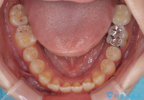 歯医者が怖い 1DAYインプラントで外科処置の恐怖を軽減の治療後